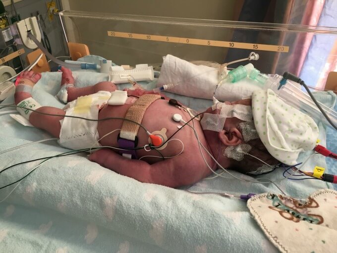 Newborn baby on life support in his bed in the NICU.
